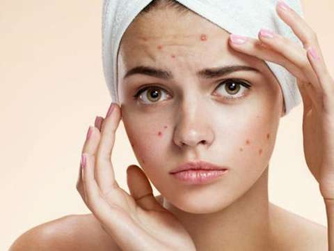Does Acne Still Bother You? Here Is What You Need To Do!