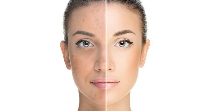 Do AHAs Really Work for Acne Treatment?