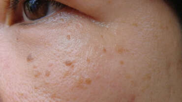 Noncancerous (benign) Skin Lesion Removal
