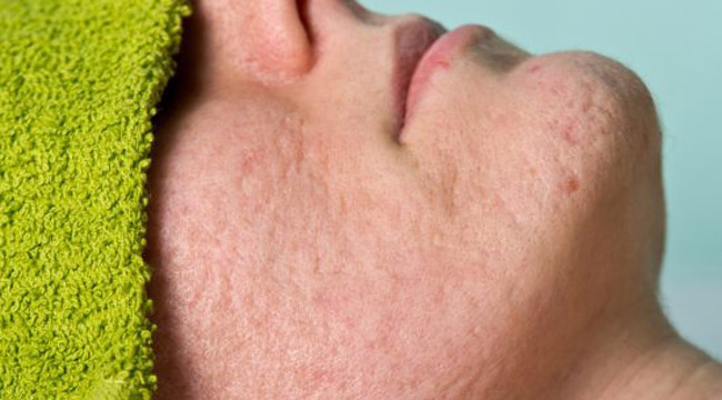 10 Treatments for Acne Scars