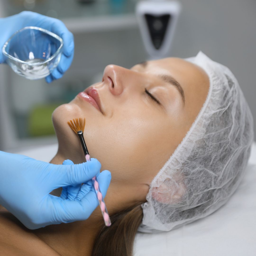 Chemical Peel - One session